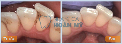 Những tác hại của cao răng có thể bạn chưa biết