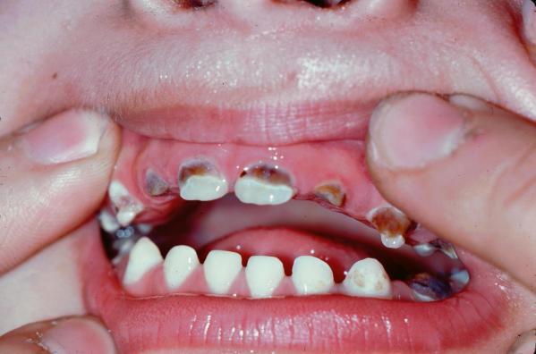 Những tác hại sâu răng sữa ở trẻ em bạn nên biết 2