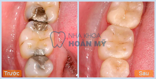 Phương pháp nào điều trị sâu răng hiệu quả nhất?