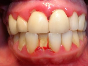 Chảy máu chân răng bị bệnh gì? Có chữa được không?