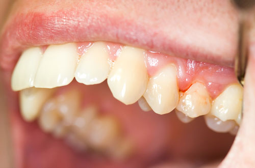 Nên làm gì khi có hiện tượng chảy máu chân răng xảy ra?