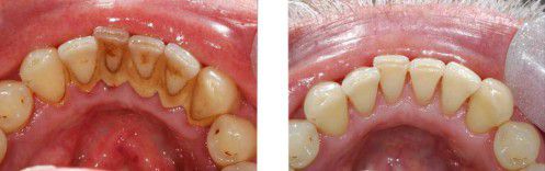 Lấy cao răng ở đâu không đau và đảm bảo an toàn nhất? 3