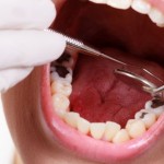 Bảng giá trám răng sâu bao nhiêu là hiệu quả nhất?