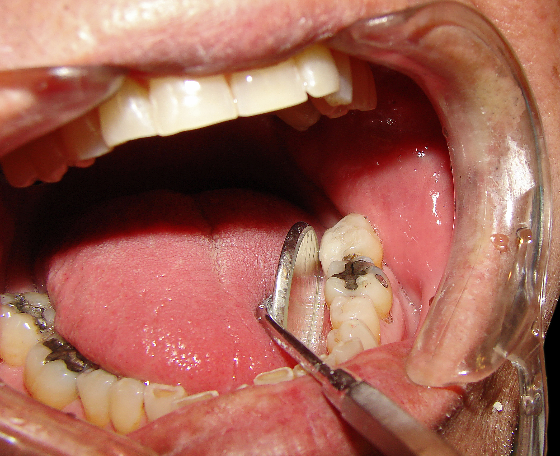Dấu hiệu nhận biết sâu răng Cực Chuẩn Xác