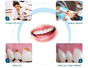Chia sẻ quy trình hàn răng sâu tại nha khoa Paris