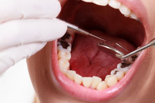 Răng hàm bị sâu có nên nhổ đi không hay vẫn giữ?