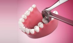 Giá tiền nhổ răng số 8 bao nhiêu là hợp lý nhất?