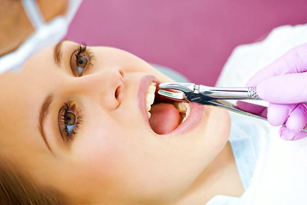 Giá nhổ răng khôn bao nhiêu là hợp lý ? Bảng giá mới nhất