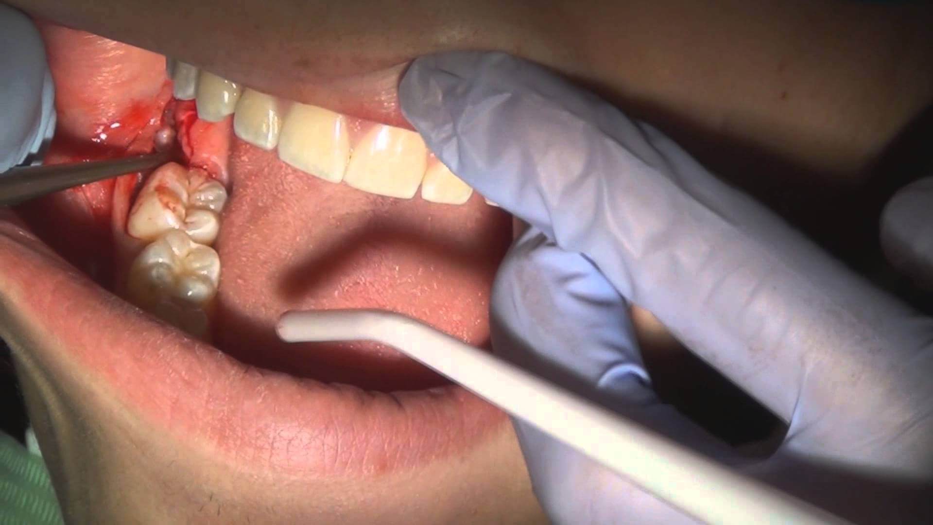 Những biến chứng khi nhổ răng số 8 thường gặp nhất