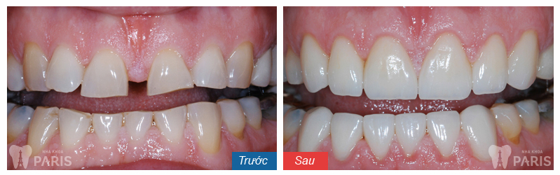 Khi nào cần niềng răng để HIỆU QUẢ TỐT NHẤT? 5