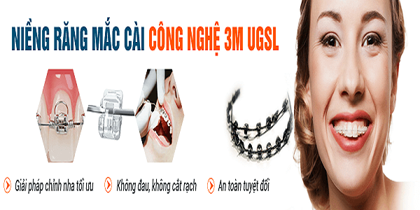 Niềng răng mất bao lâu