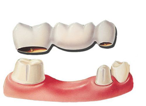 Làm răng sứ không kim loại có tốt không và vấn đề liên quan  2