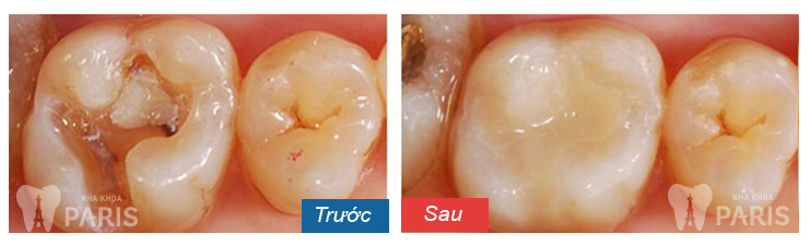 Bật mí hàn răng có ảnh hưởng gì không tới răng miệng 3