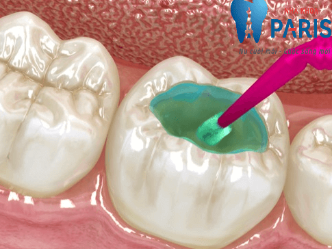 Trám răng có đau không? Cách khắc phục nào TỐT NHẤT?