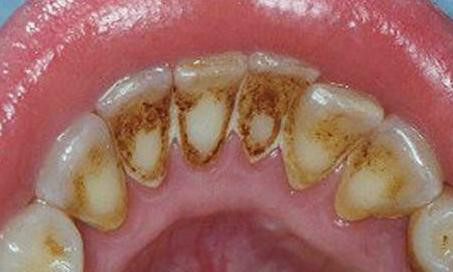Loại bỏ mảng bám răng – ngăn ngừa hình thành cao răng
