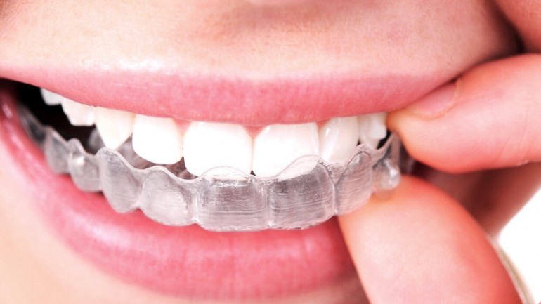 Chuyên gia chia sẻ: Tẩy trắng răng và tác hại khó lường trước