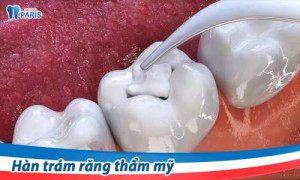 Cách hàn răng sâu nào tốt và hiệu quả nhất?