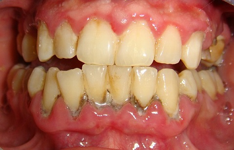 Chảy máu răng: Nguyên nhân và Cách điều trị AN TOÀN NHẤT 1
