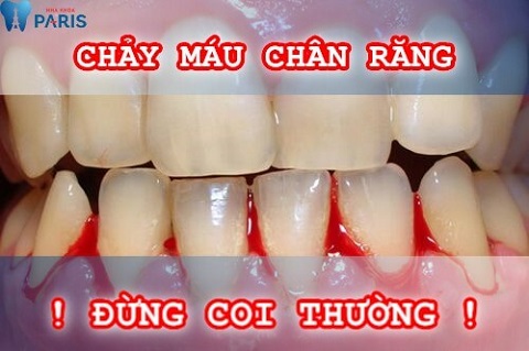 Chảy máu răng: Nguyên nhân và Cách điều trị AN TOÀN NHẤT 2