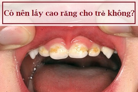 Chia sẻ: Có nên lấy cao răng cho trẻ như người lớn không? 1