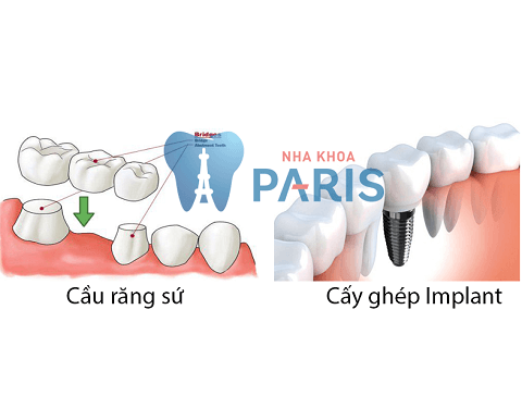 Chuyên gia giải đáp: Có nên trồng răng sứ không? 2