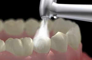 Lấy cao răng Siêu Âm – Trải nghiệm đẳng cấp 5 sao chỉ với hơn 150k