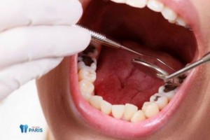 Những cách điều trị răng sâu độ 3 dứt điểm bạn nên biết