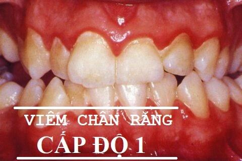 Điều trị viêm chân răng hàm HIỆU QUẢ với BÍ QUYẾT sau 1