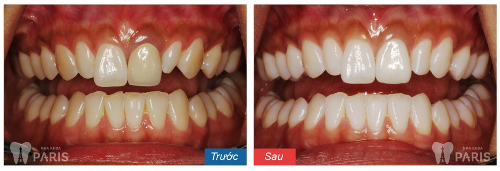 Nguyên nhân gây hôi miệng xuất phát do đâu và cách điều trị hiệu quả nhất 2