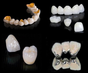 Chuyên gia chia sẻ cách xác định giá trồng răng sứ CHUẨN NHẤT