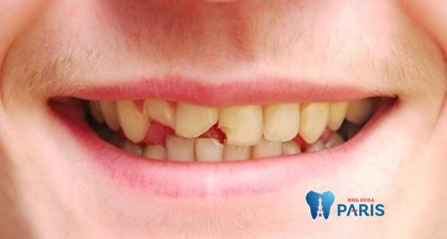 Trám răng bị mẻ mất thời gian nhanh nhất là bao lâu?
