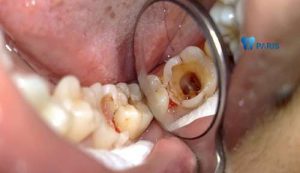 Trám răng sâu lơn ĐƯỢC hay KHÔNG? [BS Tư Vấn]