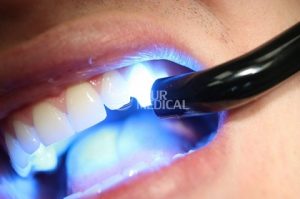 Bật mí cách làm hết nhức răng do sâu răng HIỆU QUẢ NHANH CHÓNG