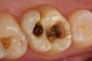 Bạn đã biết bị sâu răng phải làm sao chữa trị triệt để chưa?