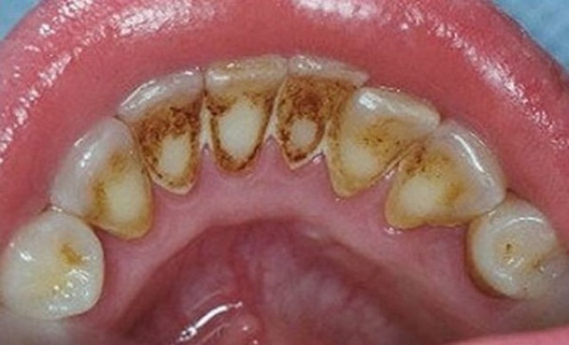 Chảy máu chân răng nguyên nhân do viêm nha chu ? 2