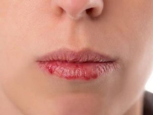 Nguyên nhân bệnh khô miệng và cách điều trị TRIỆT ĐỂ