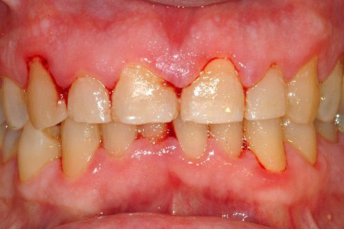 Chảy máu chân răng nguyên nhân do viêm nha chu ? 1