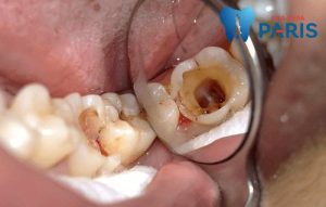 Mẹo chữa sâu răng bằng lá tía tô có thực sự hiệu quả?