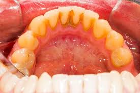 Lấy cao răng định kỳ - cạo vôi răng có làm trắng răng không ? 2