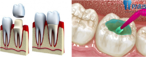 Điều bạn chưa biết về cách chữa sâu răng hiệu quả triệt để nhất 2