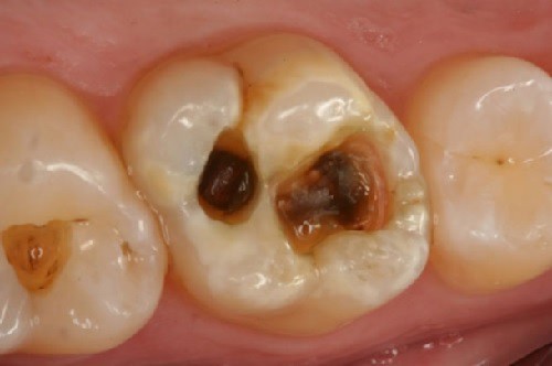 Răng sâu thối và những biến chứng khó lường