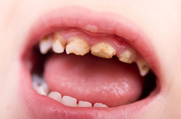 Có nên lấy cao răng ở trẻ em không?