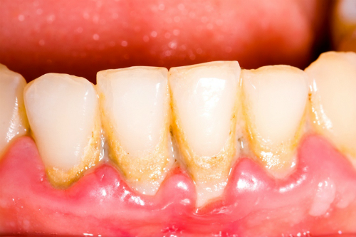 Có nên cạo vôi răng sau sinh hay không?