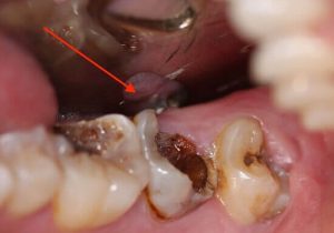 [Tư vấn]-Cách chữa sâu răng cối hiệu quả?