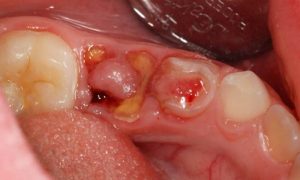 cách chữa sâu răng viêm lợi