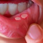 Nhiệt miệng khô môi – do đâu và cách điều trị như thế nào?